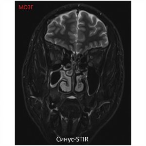 Изображение SuperVAN 1,5T МРТ