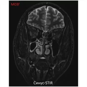 Изображение SuperVAN 1,5T МРТ