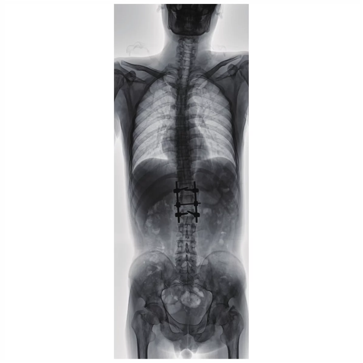 Фото Система рентгеноскопии PLD9600A Изображение Система рентгеноскопии PLD9600A